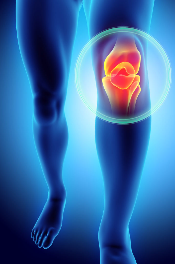 Knee Arthritis West Michigan Orthopaedics